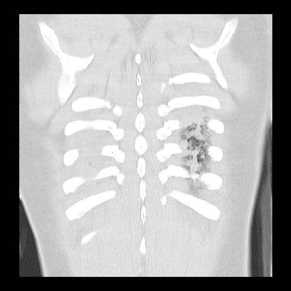 File:Acute pulmonary edema on CT (Radiopaedia 33582-34672 Coronal lung window 35).jpg