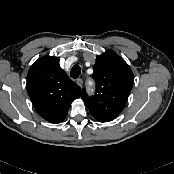 File:Acute pulmonary embolism (Radiopaedia 81677-95570 Axial C+ CTPA 3).jpg