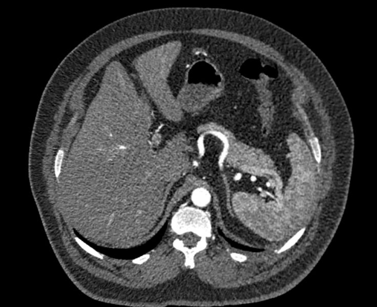 File:Acute pulmonary embolism with pulmonary infarcts (Radiopaedia 77688-89908 Axial C+ CTPA 73).jpg