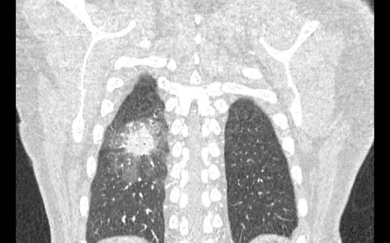 File:Acute pulmonary embolism with pulmonary infarcts (Radiopaedia 77688-89908 Coronal lung window 91).jpg