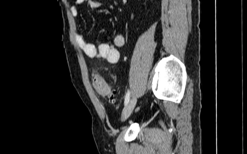 File:Acute sigmoid colon diverticulitis (Radiopaedia 55507-61976 Sagittal C+ portal venous phase 60).jpg