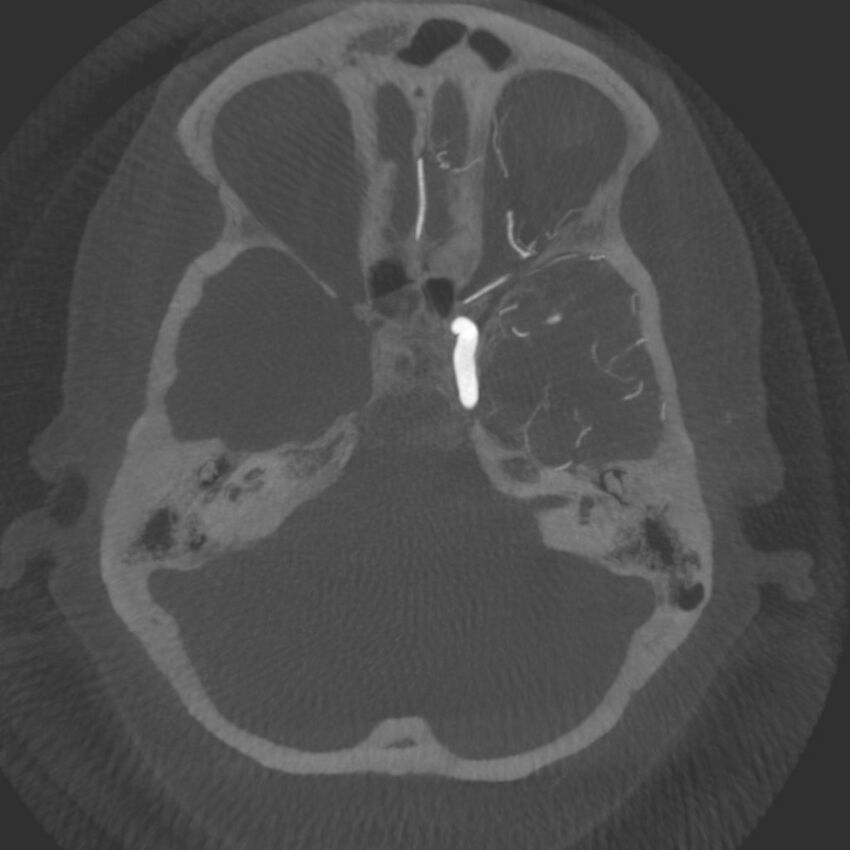 Acute subarachnoid hemorrhage and accessory anterior cerebral artery (Radiopaedia 69231-79010 C 14).jpg