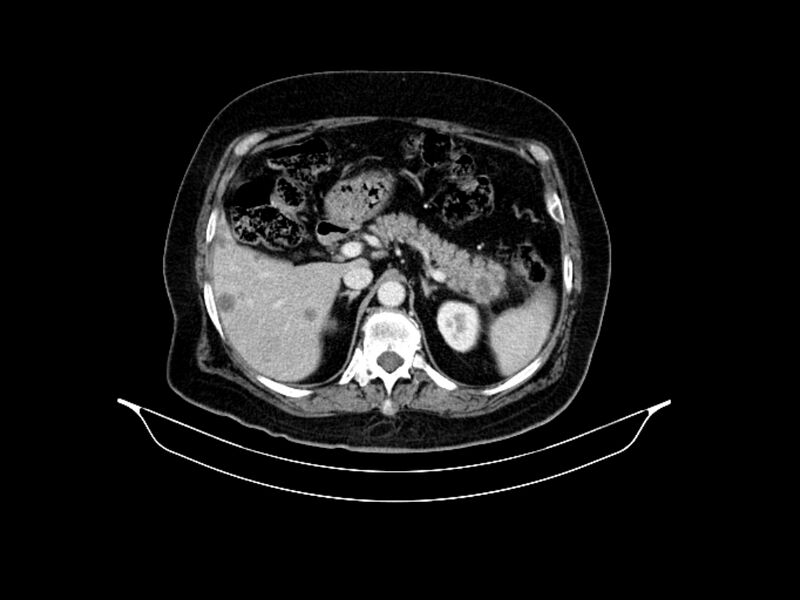 File:Adenocarcinoma of pancreas with hepatic metastasis (Radiopaedia 64332-73122 Axial C+ portal venous phase 32).jpg