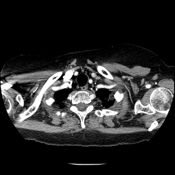File:Adenocarcinoma of the lung (Radiopaedia 41015-43755 Axial C+ portal venous phase 9).jpg