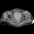 Adenomyoma of the uterus (huge) (Radiopaedia 9870-10438 Axial T1 fat sat 11).jpg