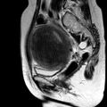 Adenomyoma of the uterus (huge) (Radiopaedia 9870-10438 Sagittal T2 15).jpg