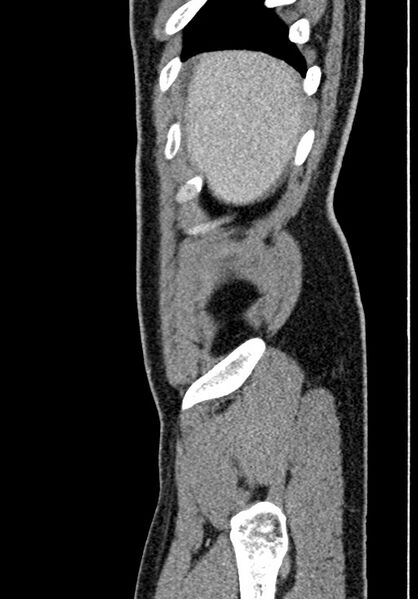 File:Adhesional small bowel obstruction (Radiopaedia 58900-66131 Sagittal C+ portal venous phase 25).jpg