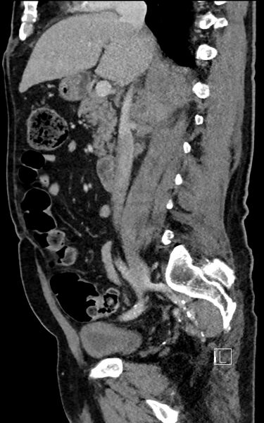 File:Adrenal lymphoma (Radiopaedia 73730-84529 Sagittal C+ portal venous phase 49).jpg