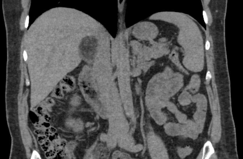 Adrenal myelolipoma (Radiopaedia 65240-74253 Coronal non-contrast 16).jpg