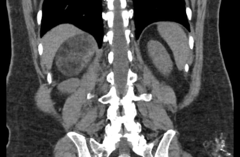 File:Adrenal myelolipoma (Radiopaedia 65240-74253 Coronal non-contrast 55).jpg