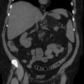 Adrenal myelolipoma (Radiopaedia 8216-9068 non-contrast 4).jpg