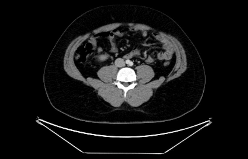 File:Adrenocortical carcinoma (Radiopaedia 80134-93438 Axial C+ portal venous phase 79).jpg