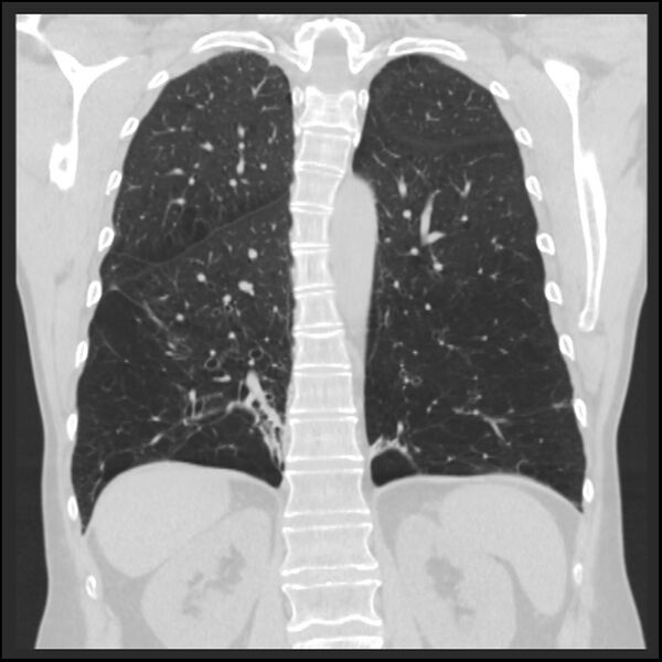 File:Alpha-1-antitrypsin deficiency (Radiopaedia 40993-43722 Coronal lung window 74).jpg
