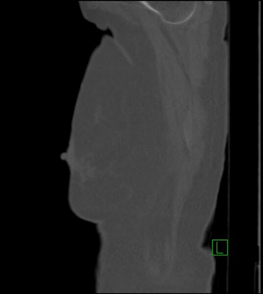 File:Amiodarone deposition in the liver (Radiopaedia 77587-89780 Sagittal bone window 93).jpg