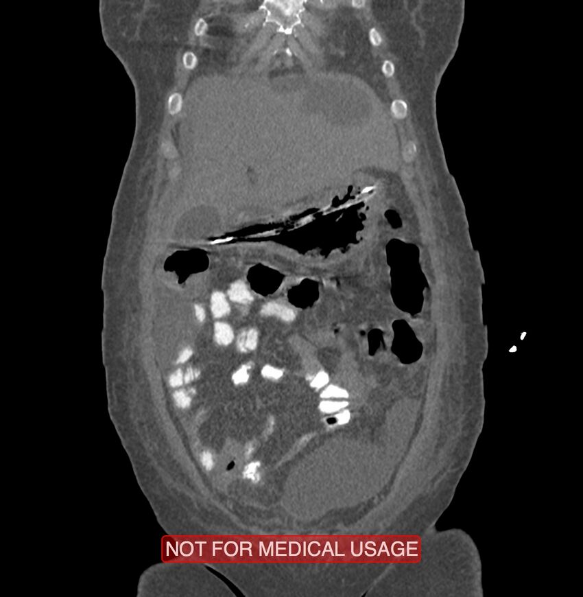 Amoebic enterocolitis with liver abscess (Radiopaedia 35100-36609 B 26).jpg