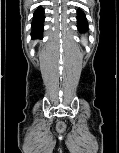 File:Ampullary adenocarcinoma (Radiopaedia 86093-102032 C 62).jpg