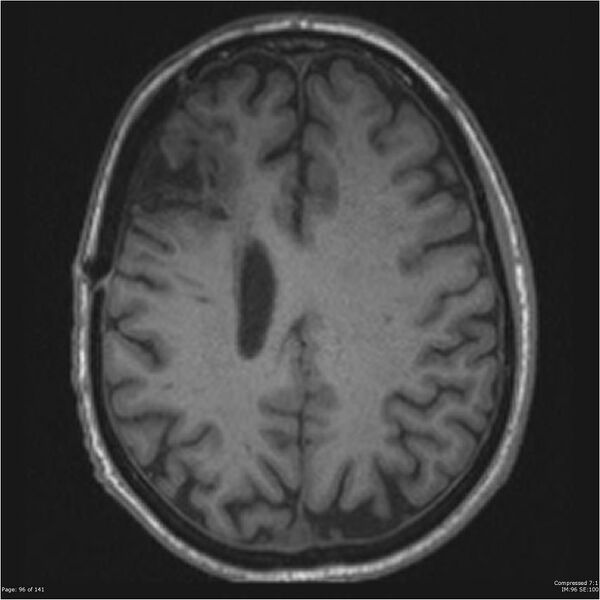 File:Anaplastic meningioma with recurrence (Radiopaedia 34452-35788 Axial T1 94).jpg