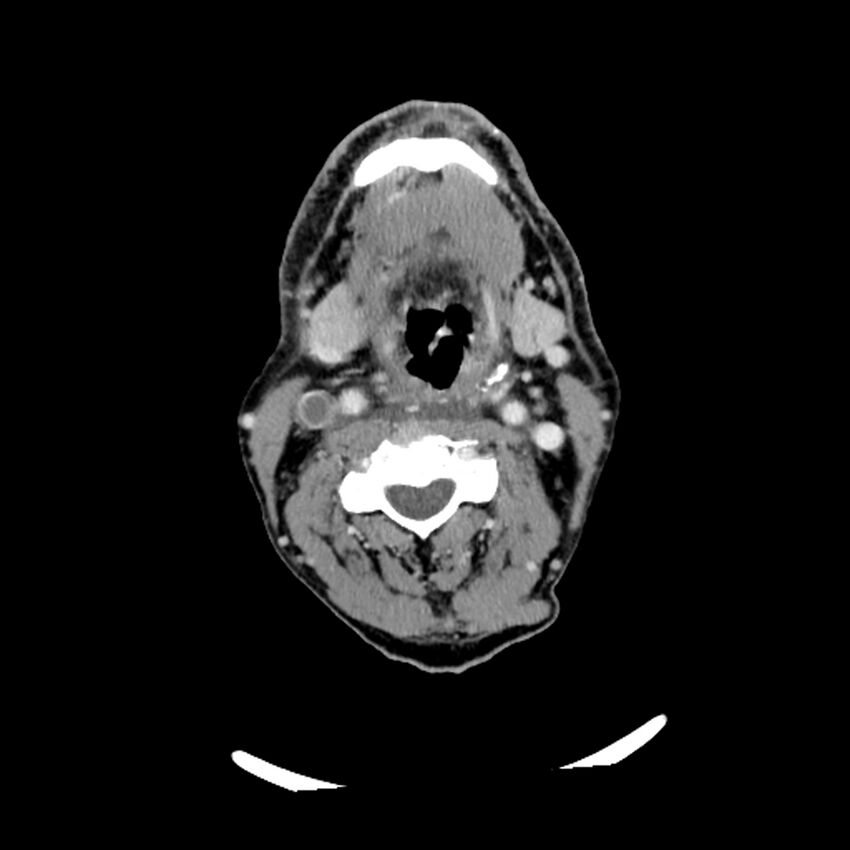 Anaplastic thyroid carcinoma (Radiopaedia 79087-92034 B 75).jpg