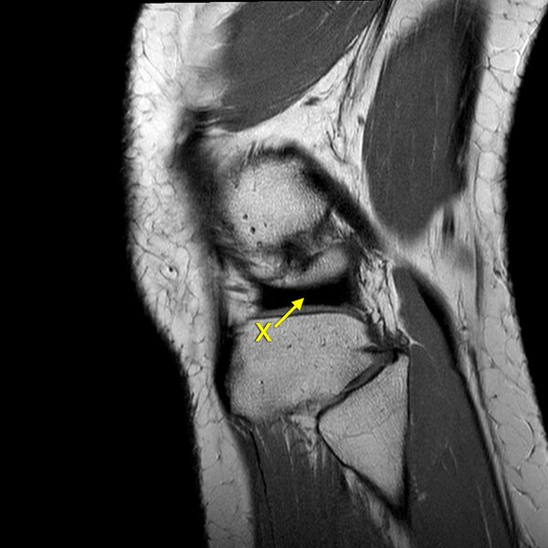 File:Anatomy Quiz (MRI knee) (Radiopaedia 43478-46865 A 23).jpeg