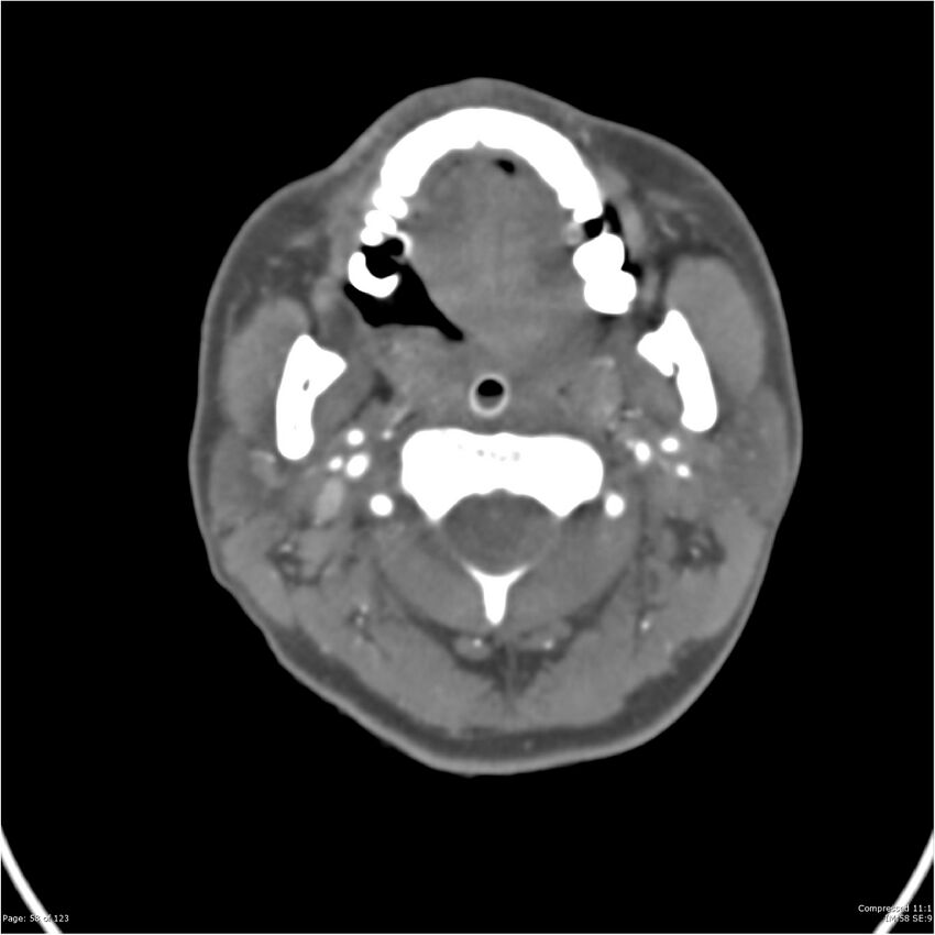 Aneurysmal subarachnoid hemorrhage and Moya Moya disease (Radiopaedia 34306-35593 Axial CT COW 58).jpg