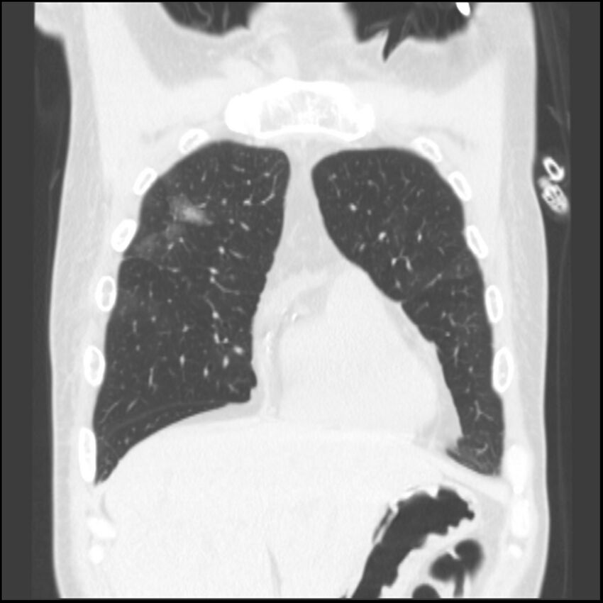 Angioinvasive aspergillosis (Radiopaedia 43957-47466 Coronal lung window 73).jpg