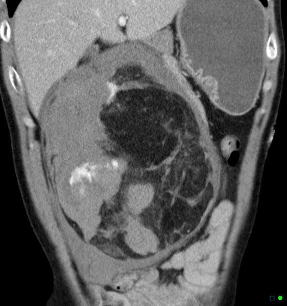 File:Angiomyolipoma (large, hemorrhagic) (Radiopaedia 19228-19241 E 1).jpg
