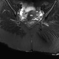 Ano-vaginal fistula (Radiopaedia 29765-30284 Coronal STIR 19).jpg