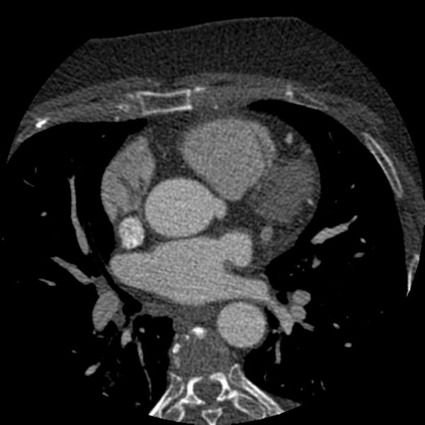 File:Anomalous origin of left circumflex artery from right coronary sinus (Radiopaedia 72563-83117 B 44).jpg