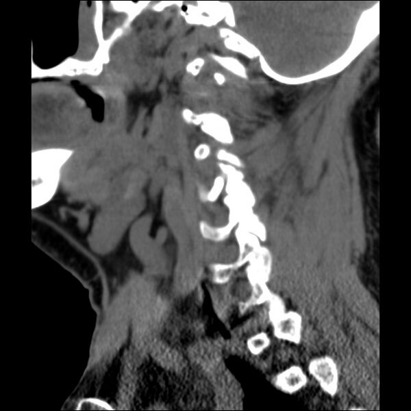 File:Anterior cervical postdiscectomy arthrodesis (Radiopaedia 32678-33646 C 34).jpg
