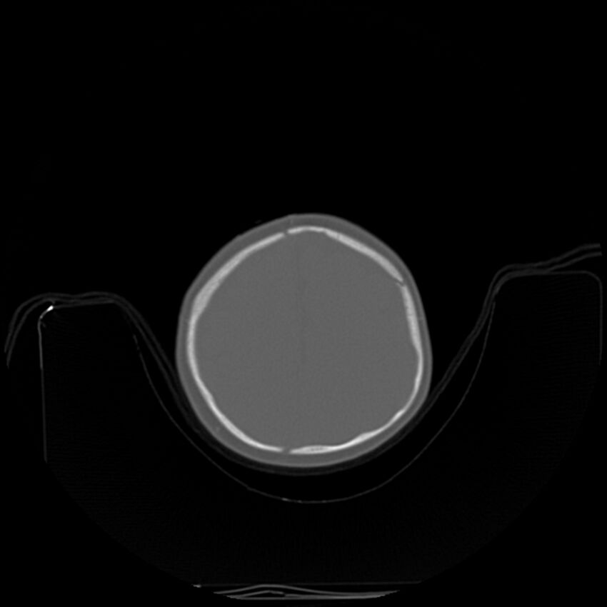 Anterior plagiocephaly (Radiopaedia 71836-82273 C 83).jpg