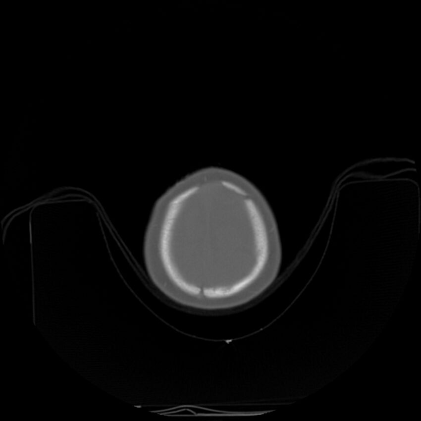 Anterior plagiocephaly (Radiopaedia 71836-82273 C 97).jpg
