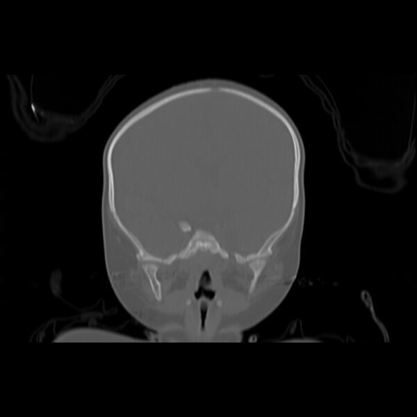 File:Anterior plagiocephaly (Radiopaedia 71836-82273 Coronal bone window 1).jpg