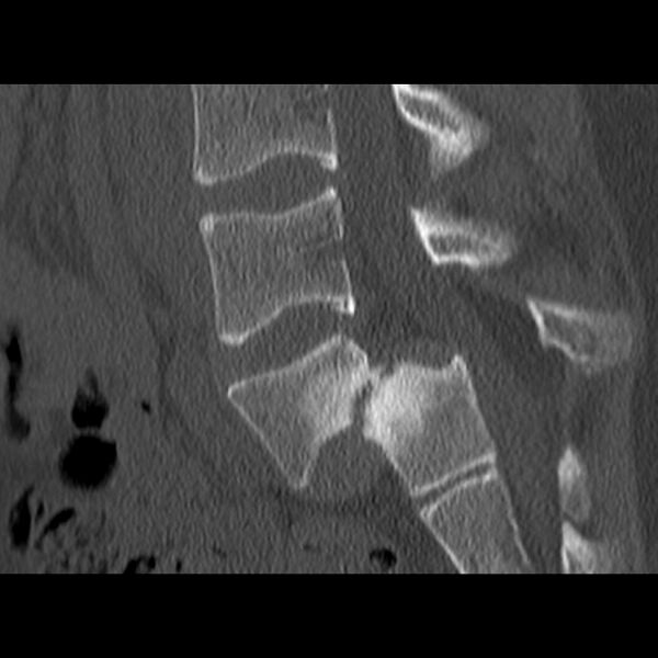 File:Anterolisthesis (Radiopaedia 22226-22263 Sagittal bone window 11).jpg