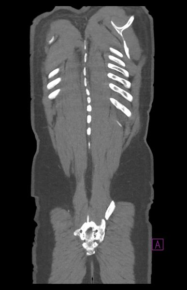 File:Aortectomy and axillary-bifemoral bypass (Radiopaedia 28303-28545 C 85).jpg