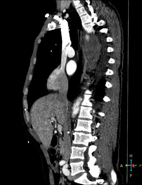 File:Aortic aneurysm and penetrating ulcer (Radiopaedia 23590-23704 C 28).jpg