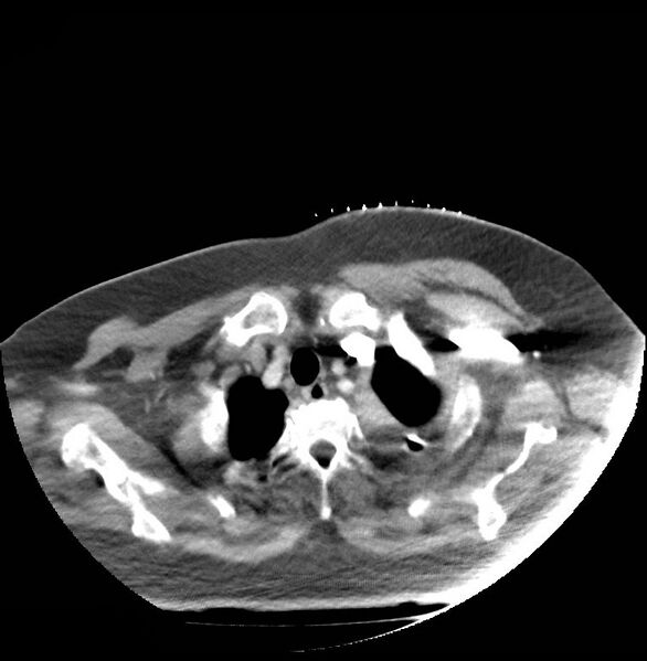 File:Aortic arch false aneurysm (Radiopaedia 14667-14588 A 1).jpg