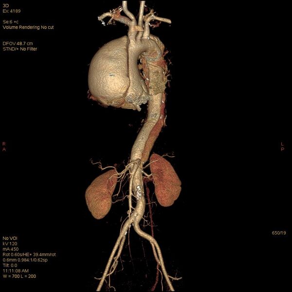 File:Aortic dissection (Radiopaedia 25350-25604 E 19).jpg