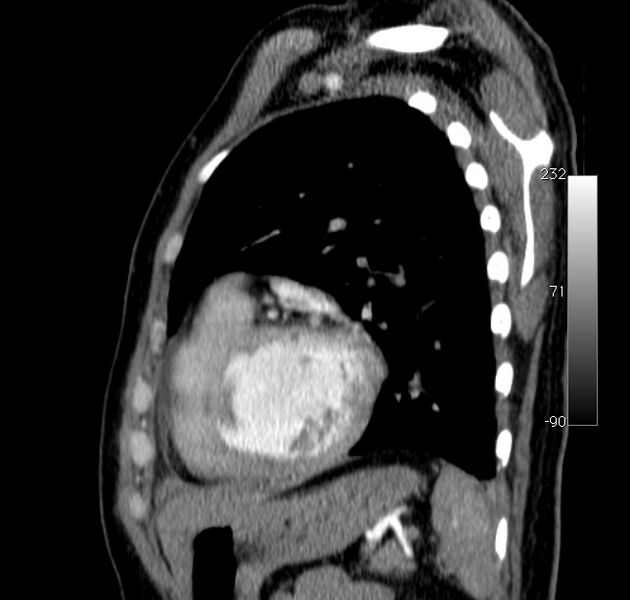 File:Aortic dissection - Stanford type A (Radiopaedia 29247-29659 C 9).jpg
