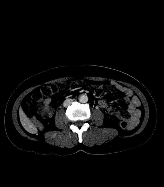 File:Aortic dissection with renal ischemia (Radiopaedia 76573-88338 B 45).jpg