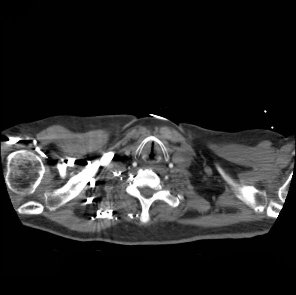 File:Aortic dissection with rupture into pericardium (Radiopaedia 12384-12647 A 2).jpg