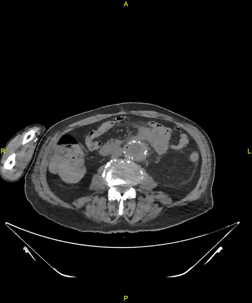 File:Aortoenteric fistula (Radiopaedia 84308-99603 Axial non-contrast 199).jpg