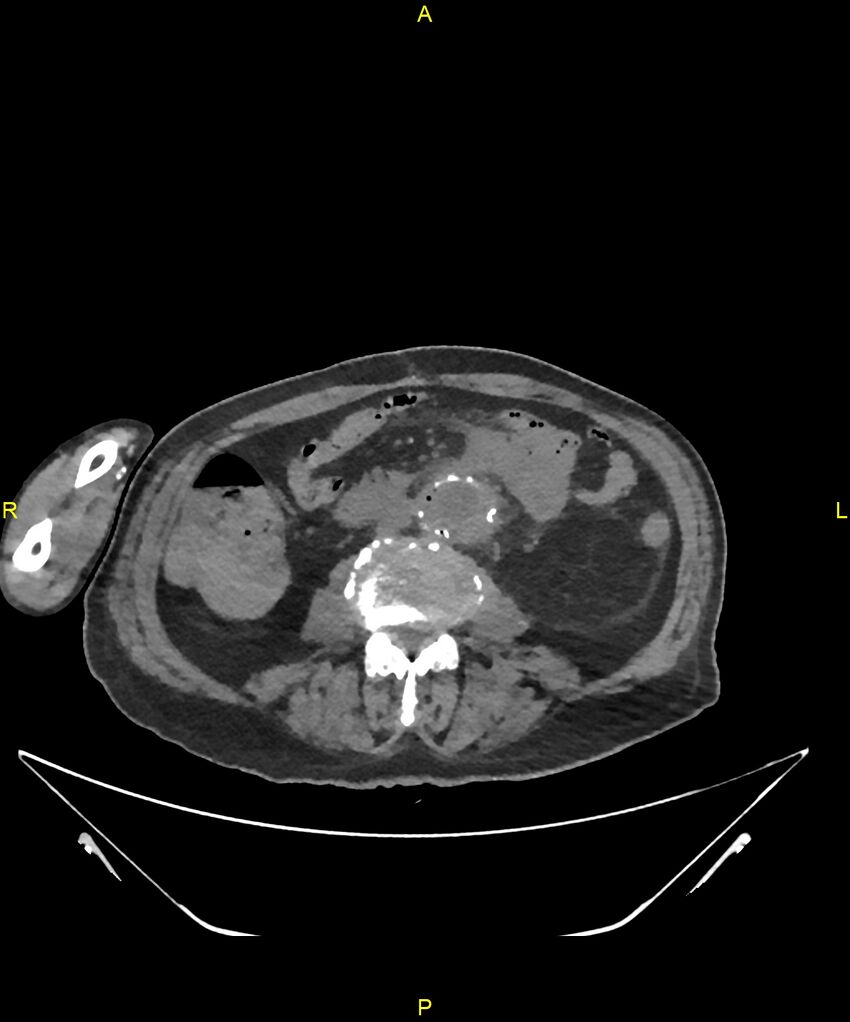 Aortoenteric fistula (Radiopaedia 84308-99603 Axial non-contrast 199).jpg