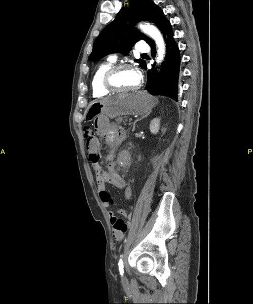 File:Aortoenteric fistula (Radiopaedia 84308-99603 C 228).jpg