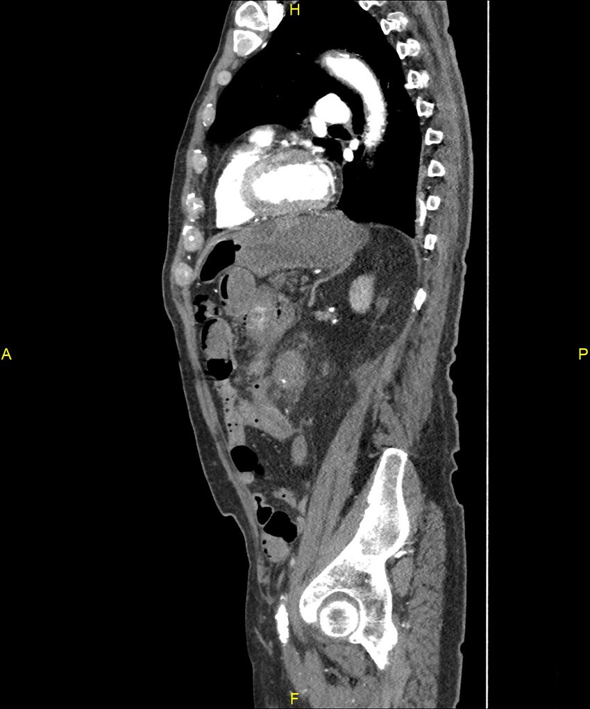 Aortoenteric fistula (Radiopaedia 84308-99603 C 228).jpg