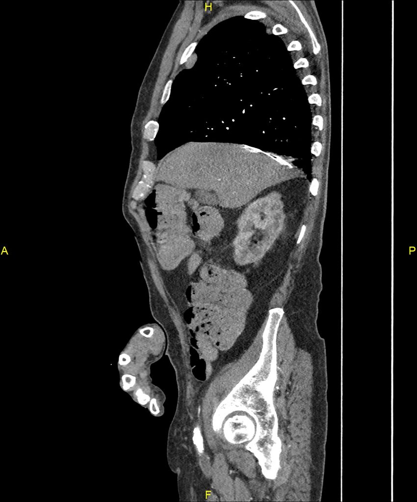 Aortoenteric fistula (Radiopaedia 84308-99603 C 91).jpg
