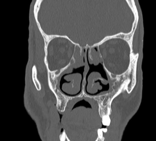 File:Aplastic maxillary sinuses (Radiopaedia 60030-67561 Coronal non-contrast 18).jpg