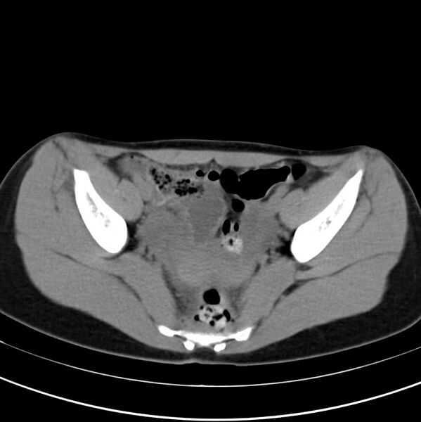File:Appendicitis and incidental bicornuate uterus (Radiopaedia 22833-22853 Axial non-contrast 39).jpg