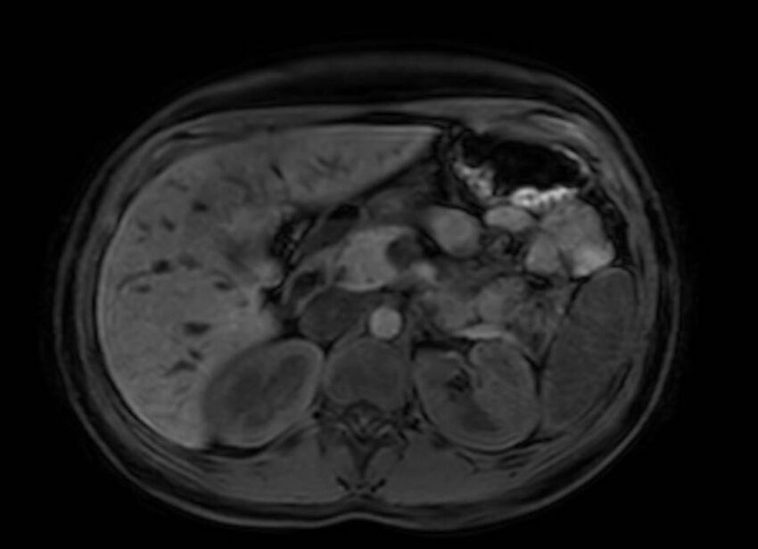Appendicitis in gravida (MRI) (Radiopaedia 89433-106395 Axial DIXON 38).jpg