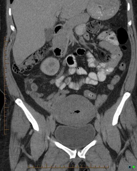 File:Appendicitis post recent cesarian section (Radiopaedia 29594-30102 D 12).jpg