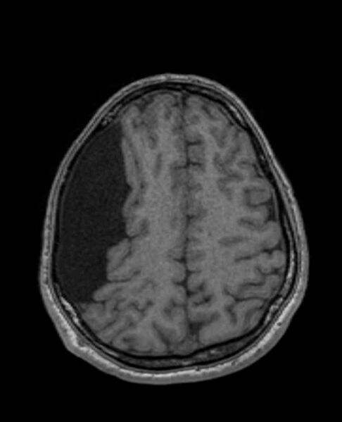 File:Arachnoid cyst- extremely large (Radiopaedia 68741-78451 Axial T1 59).jpg